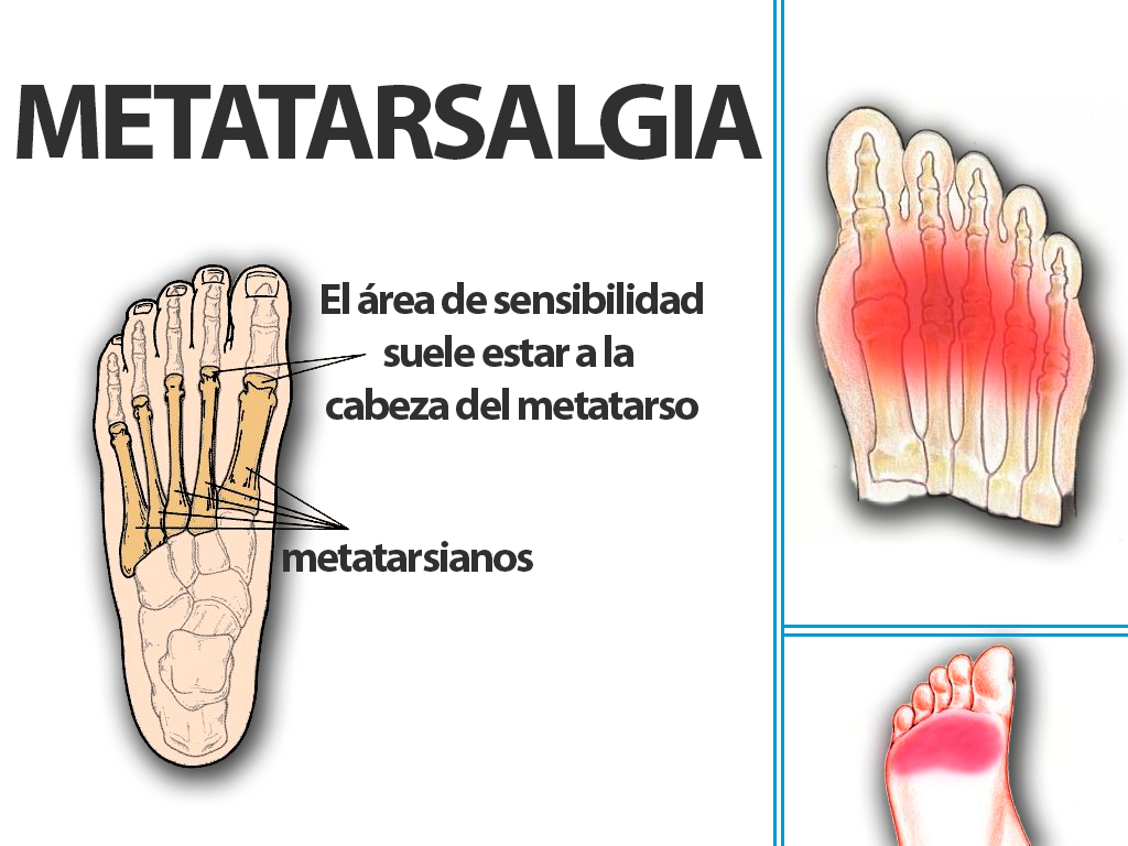 Dolor de pies