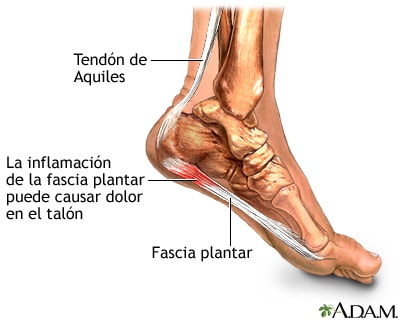 fascitis plantar