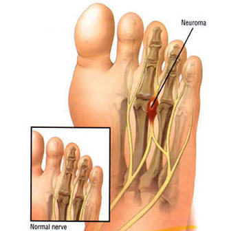 Neuroma de morton