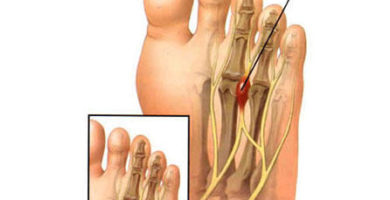 Neuroma de morton