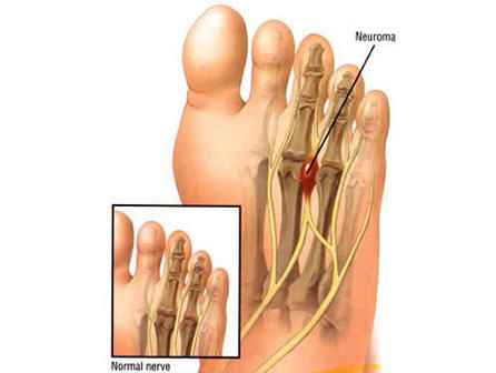 Neuroma de morton