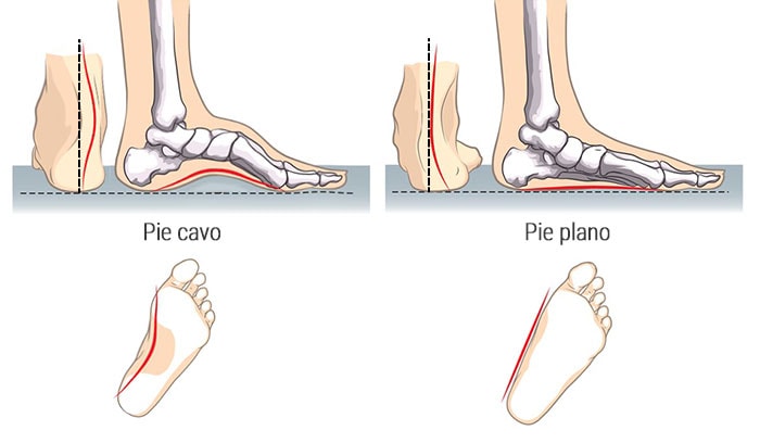 pie cavo y pie plano