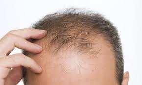 alopecia