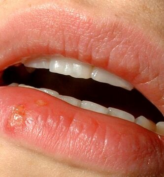 Herpes labial