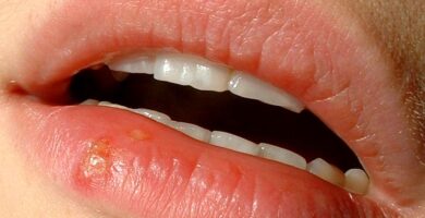 Herpes labial