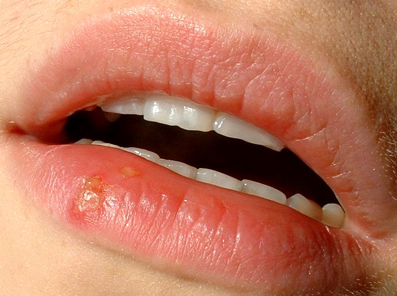 Herpes labial