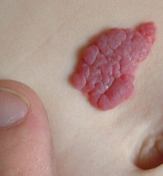 hemangioma