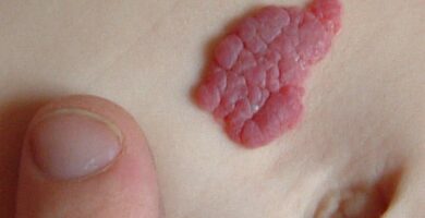 hemangioma