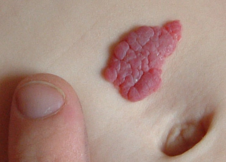 hemangioma