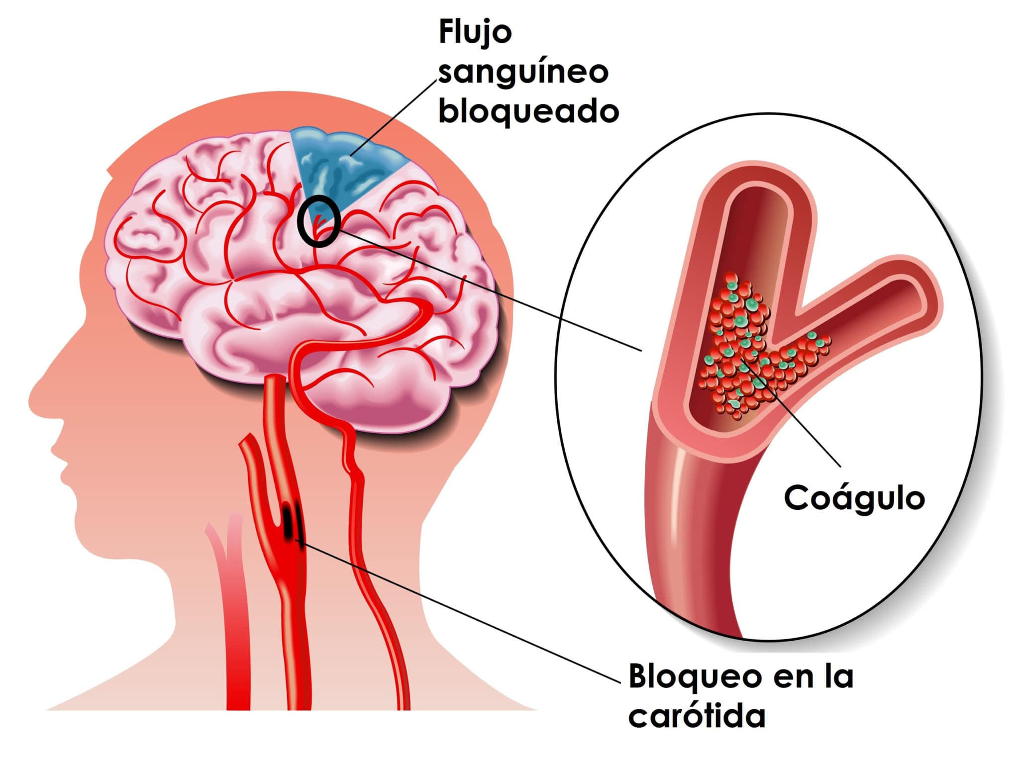 ¿Qué es un ictus?