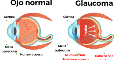 glaucoma