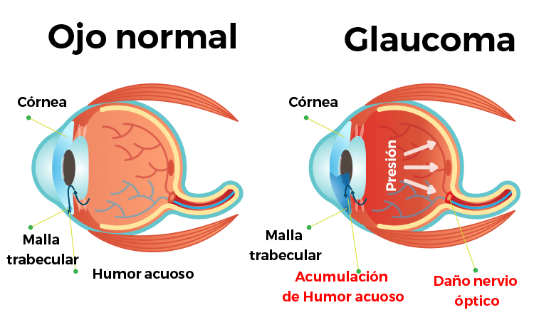 glaucoma