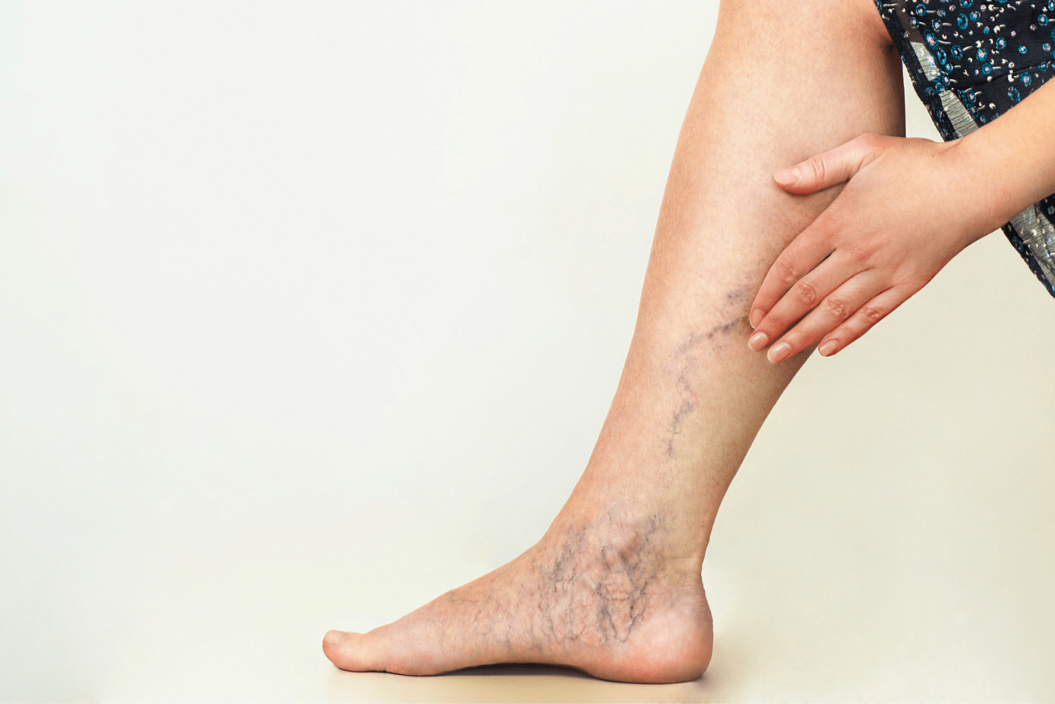 👉 ¿Qué son las varices? | Todo lo que debes saber  