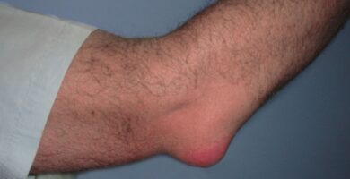 bursitis