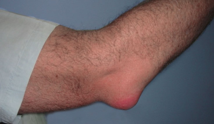 bursitis