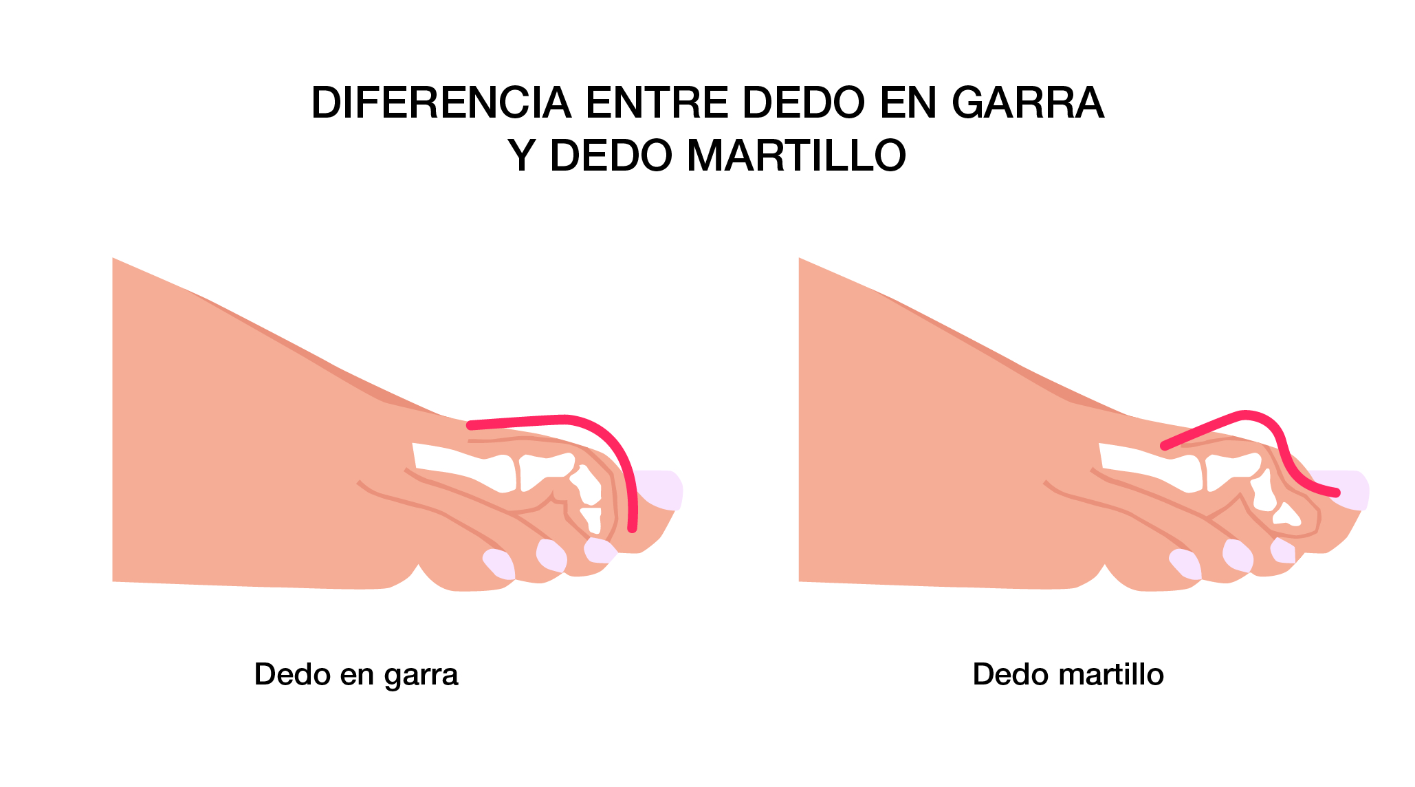 👉 Diferencia entre dedo en martillo y dedo en garra 