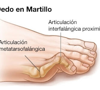 dedo en martillo