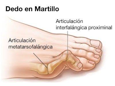 dedo en martillo