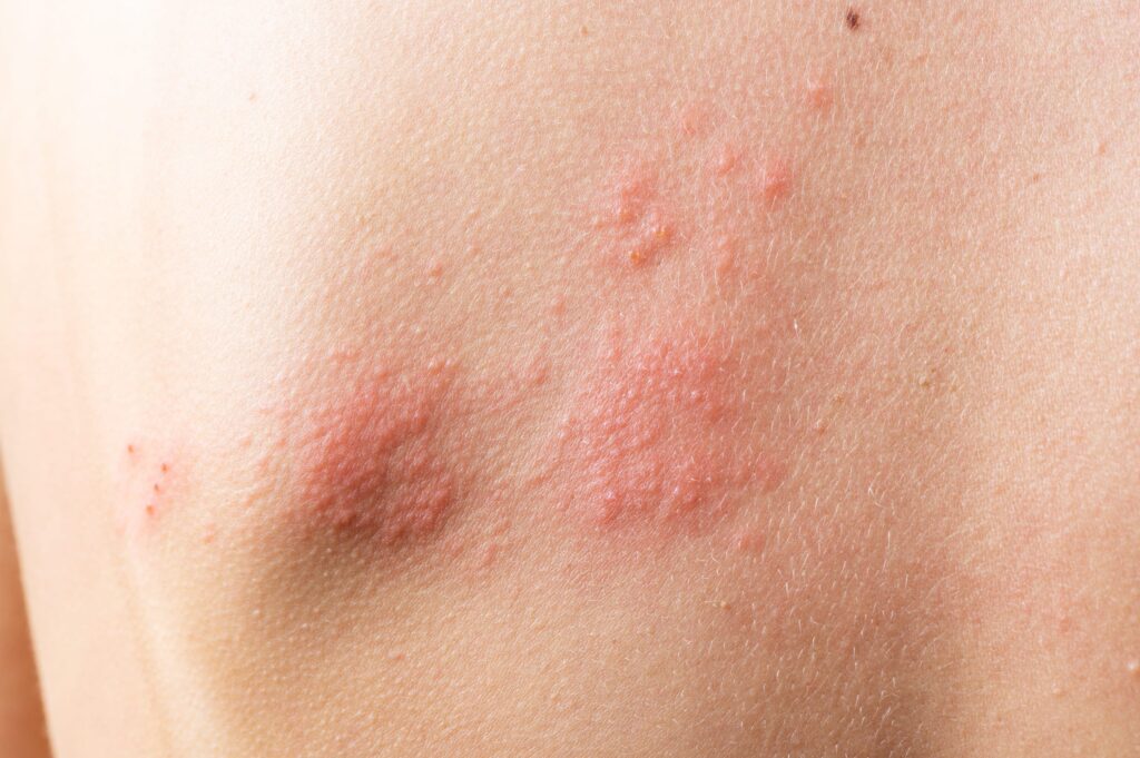 dermatitis atópica