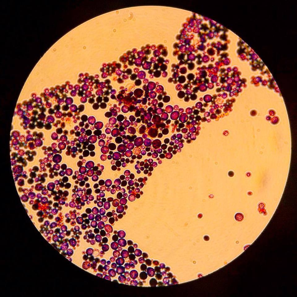 Candidiasis