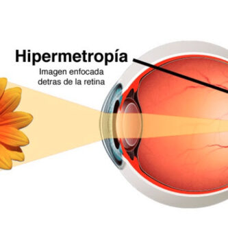 hipermetropía