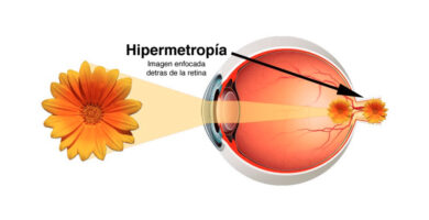 hipermetropía