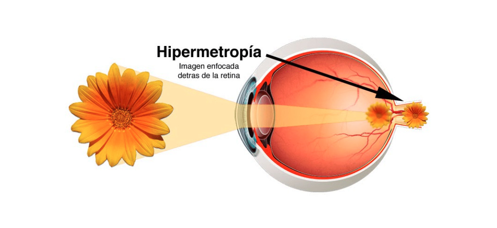 hipermetropía