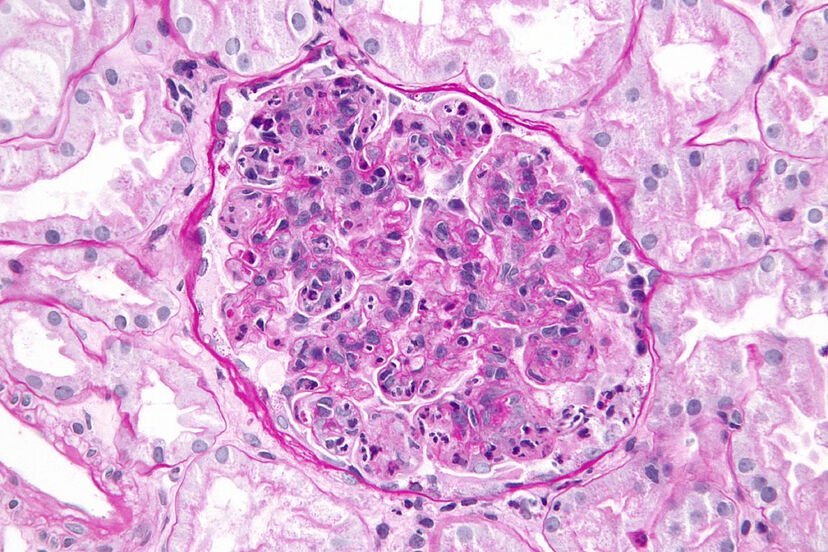 Glomerulonefritis