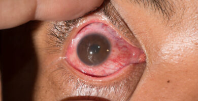 Uveitis