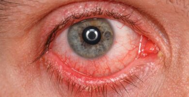 conjuntivitis