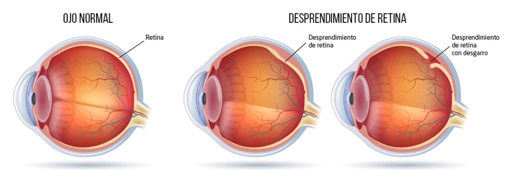 desprendimiento de retina