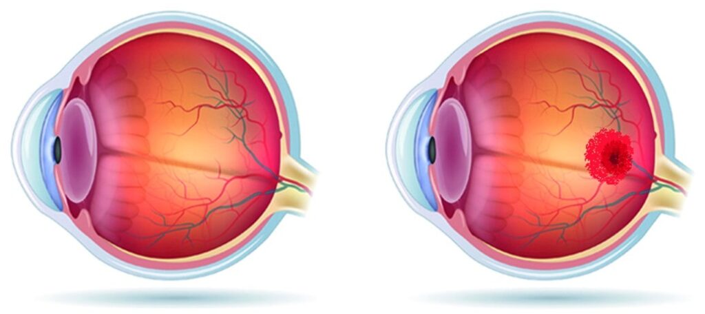 degeneración macular