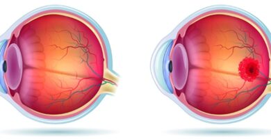 degeneración macular