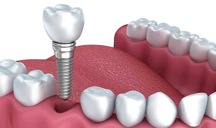 implantes dentales 