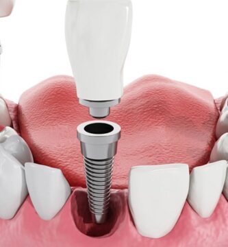 implantes dentales