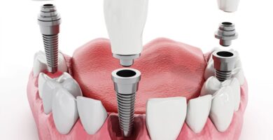 implantes dentales