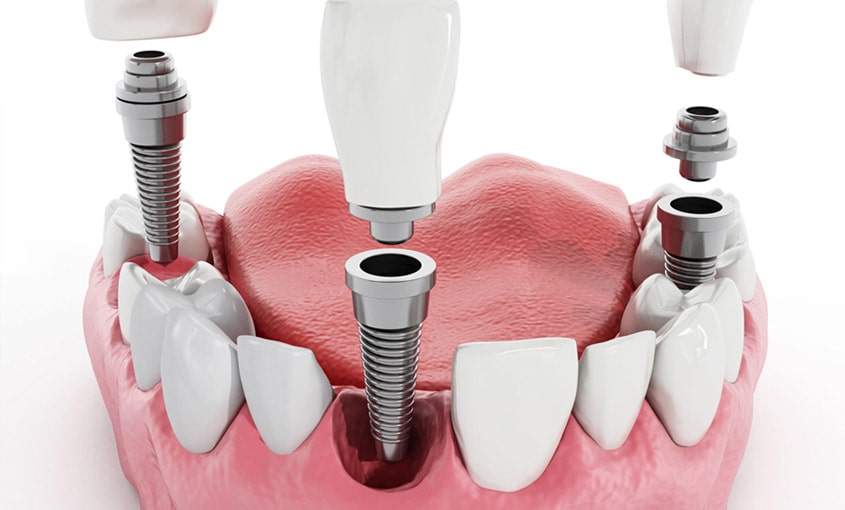 implantes dentales