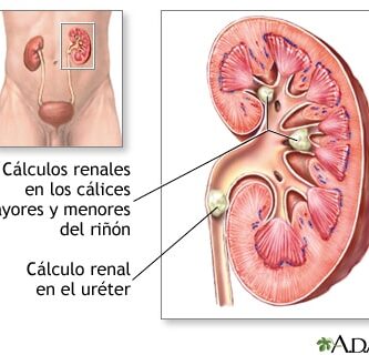 cálculos renales