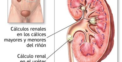 cálculos renales