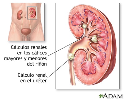 cálculos renales