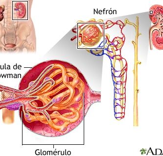 síndrome nefrótico