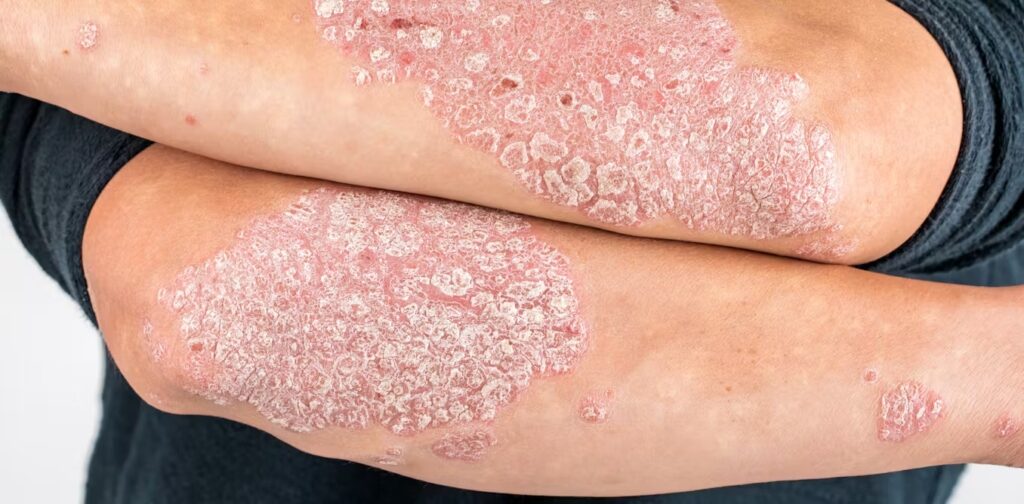 psoriasis