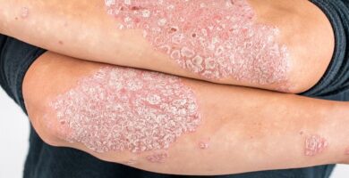 psoriasis